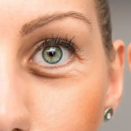 Behandlung von Tränensäcken ohne OP bei Eye Refine Hamburg