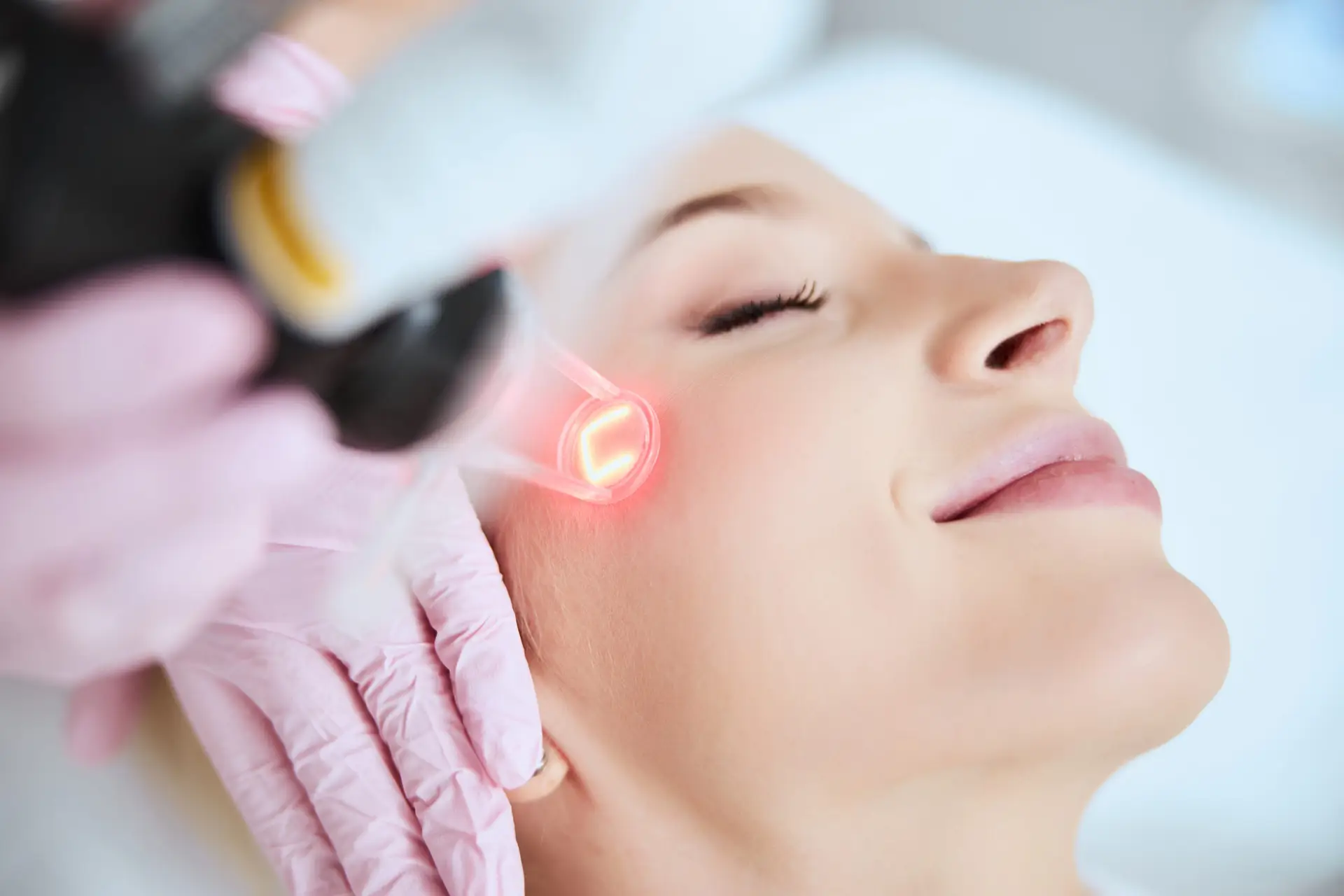 CO2 Laser Hautverjüngung Skin Resurfacing- Eye Refine Hamburg