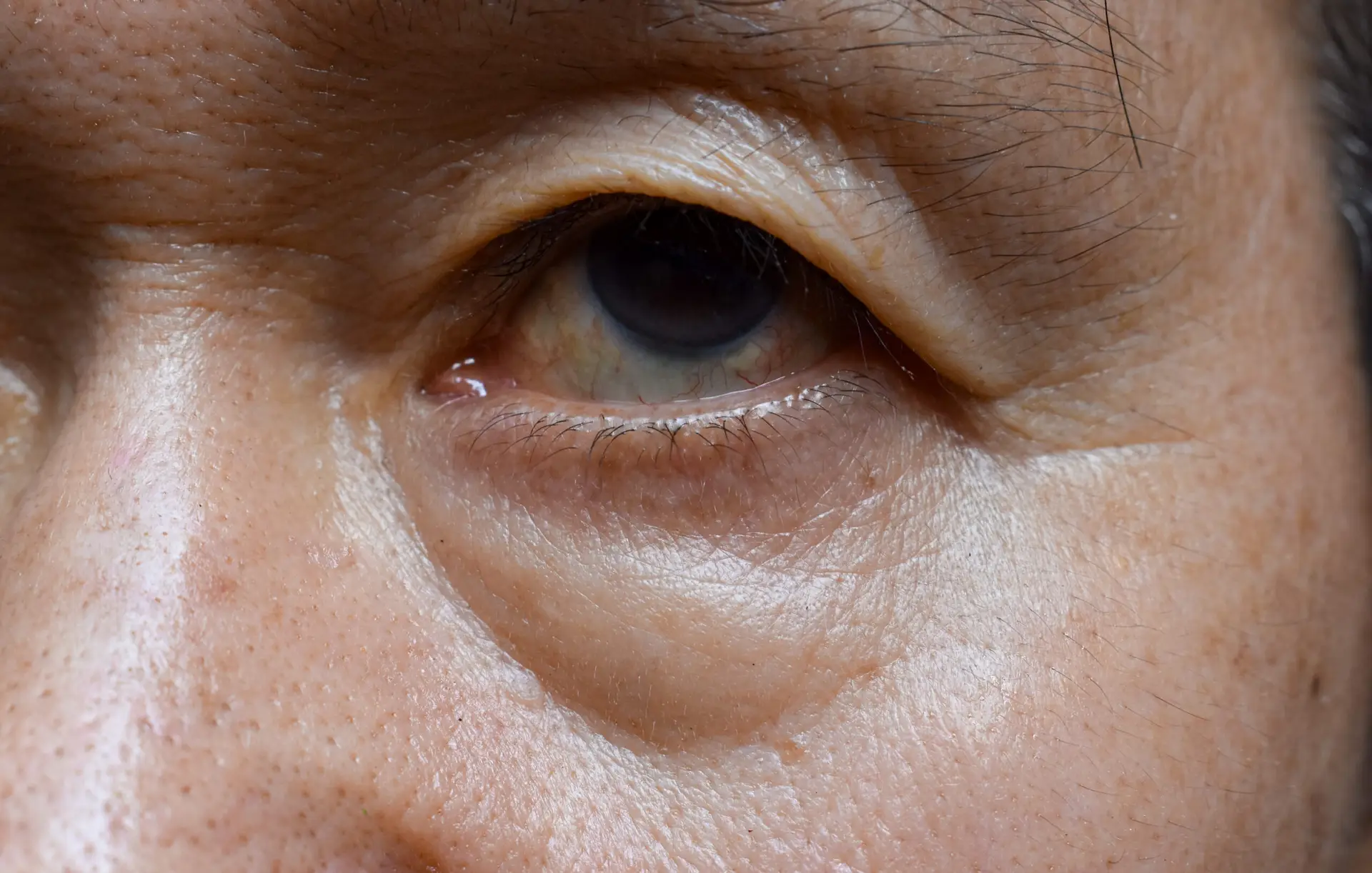 Tränensäcke behandeln ohne OP - Eye Refine Hamburg