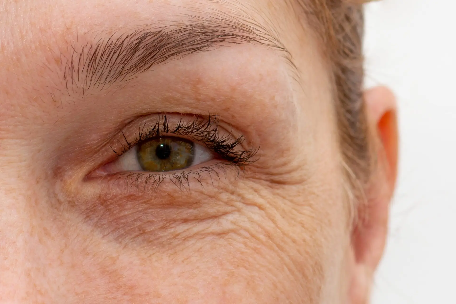 Augenfalten behandeln - Eye Refine Hamburg
